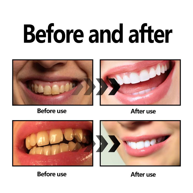Zahnaufhellungspulver, Holzkoh – Teeth Whitening With Baking Soda Bewertung und Preis