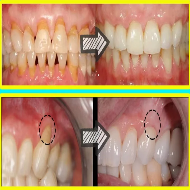 Schnell reparierendes Zahnflei – Teeth Whitening With Baking Soda Bewertung und Preis
