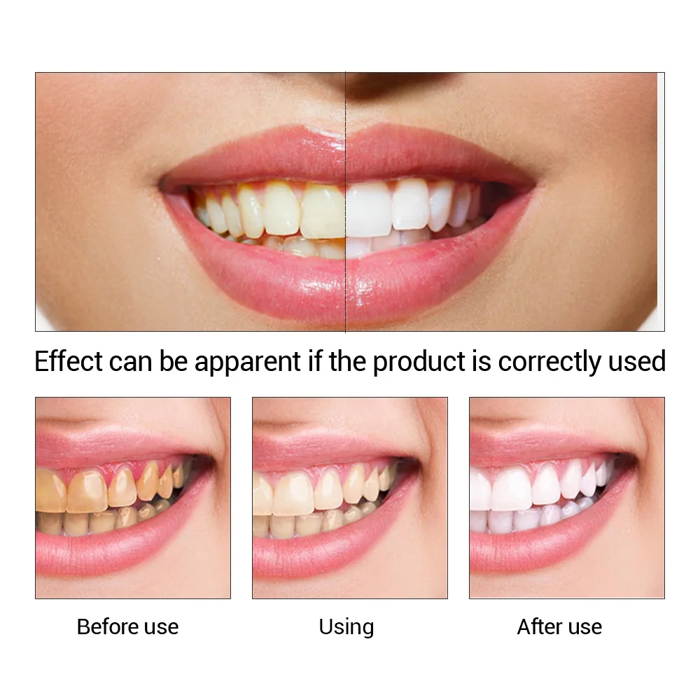 FTEENPLY Zahnaufhellung Essenz – Teeth Whitening Natural Bewertung und Preis