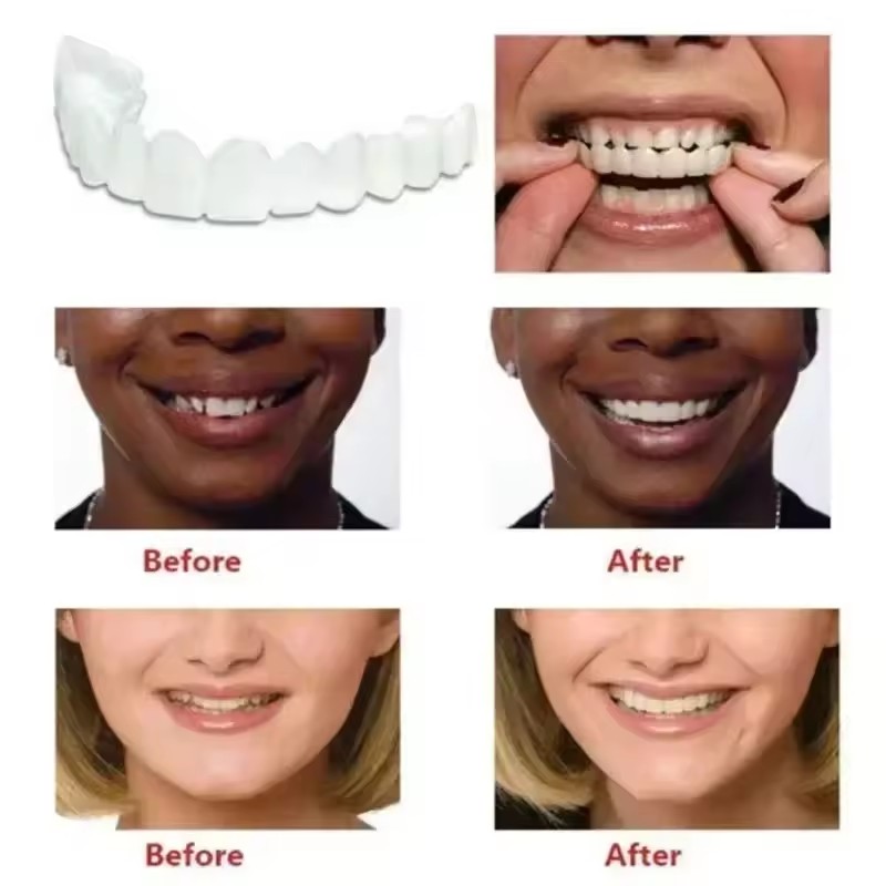 Zahn-Veneers Zahnaufhellung Za – Teeth Whitening With Braces Bewertung und Preis