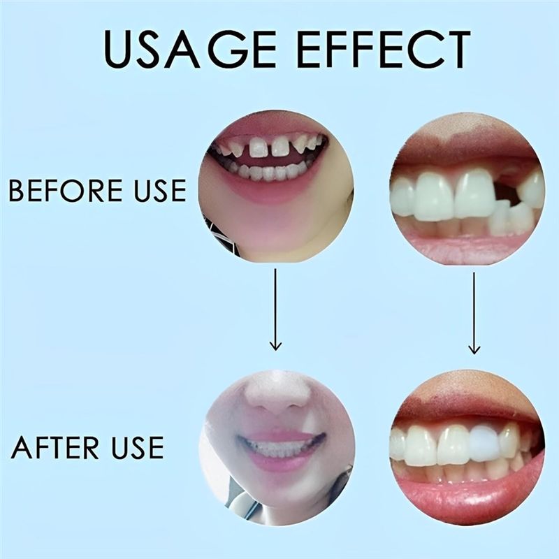 [NEU! ABMK】 2 Paar, Wiederhers – Teeth Whitening With Braces Bewertung und Preis